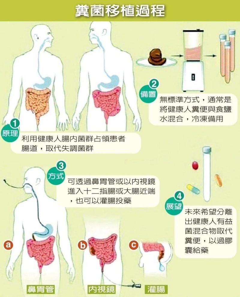 粪菌移植减肥怎么样捐粪便年入8.3万捐粪便怎么申请